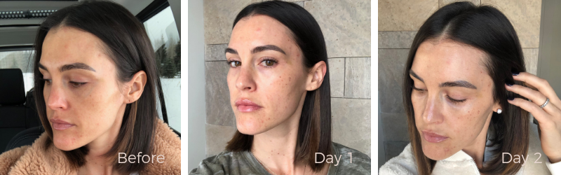 BBL Laser skincare