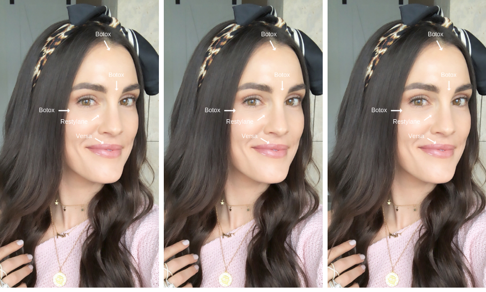 botox and filler 101