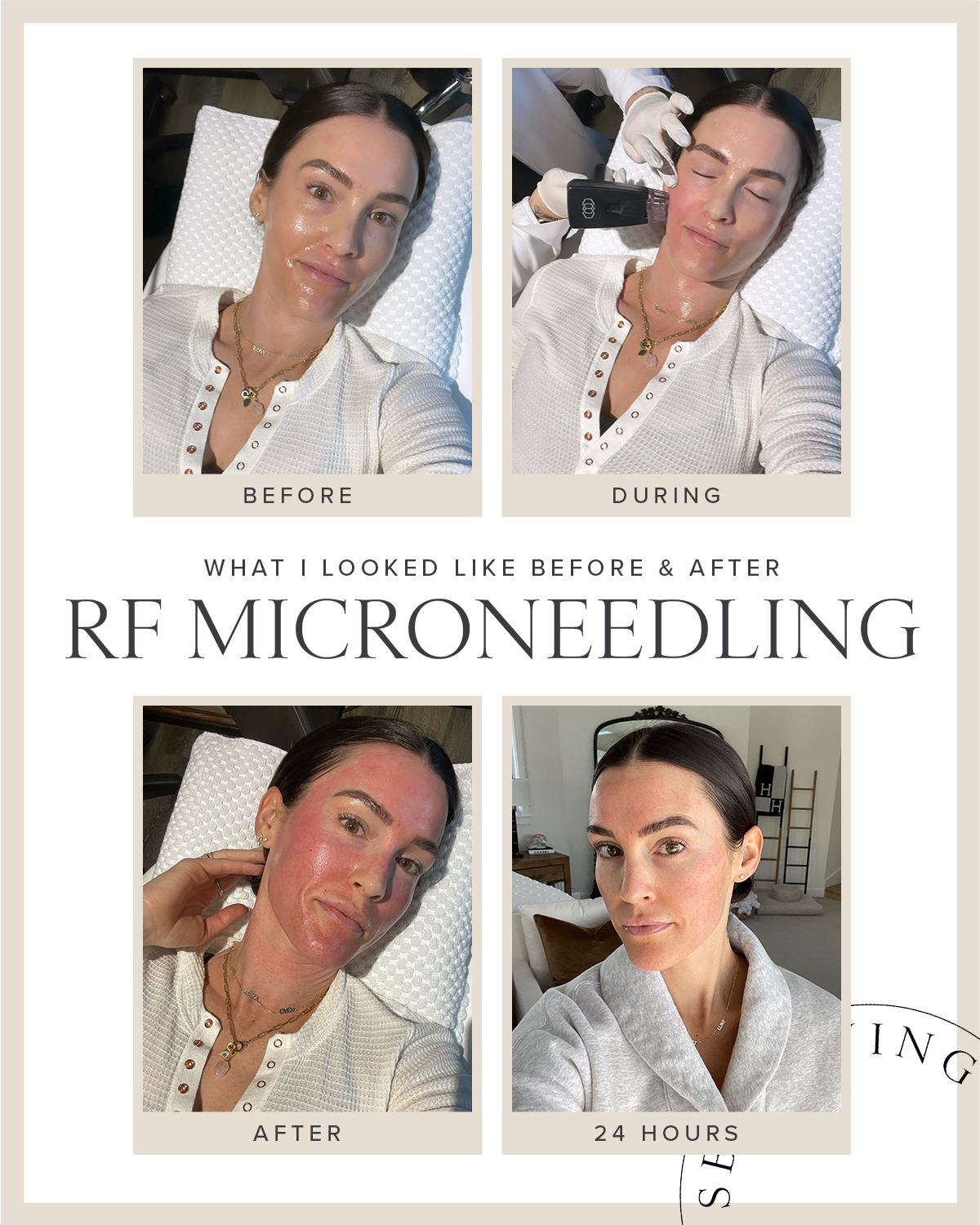 rf microneedling 101