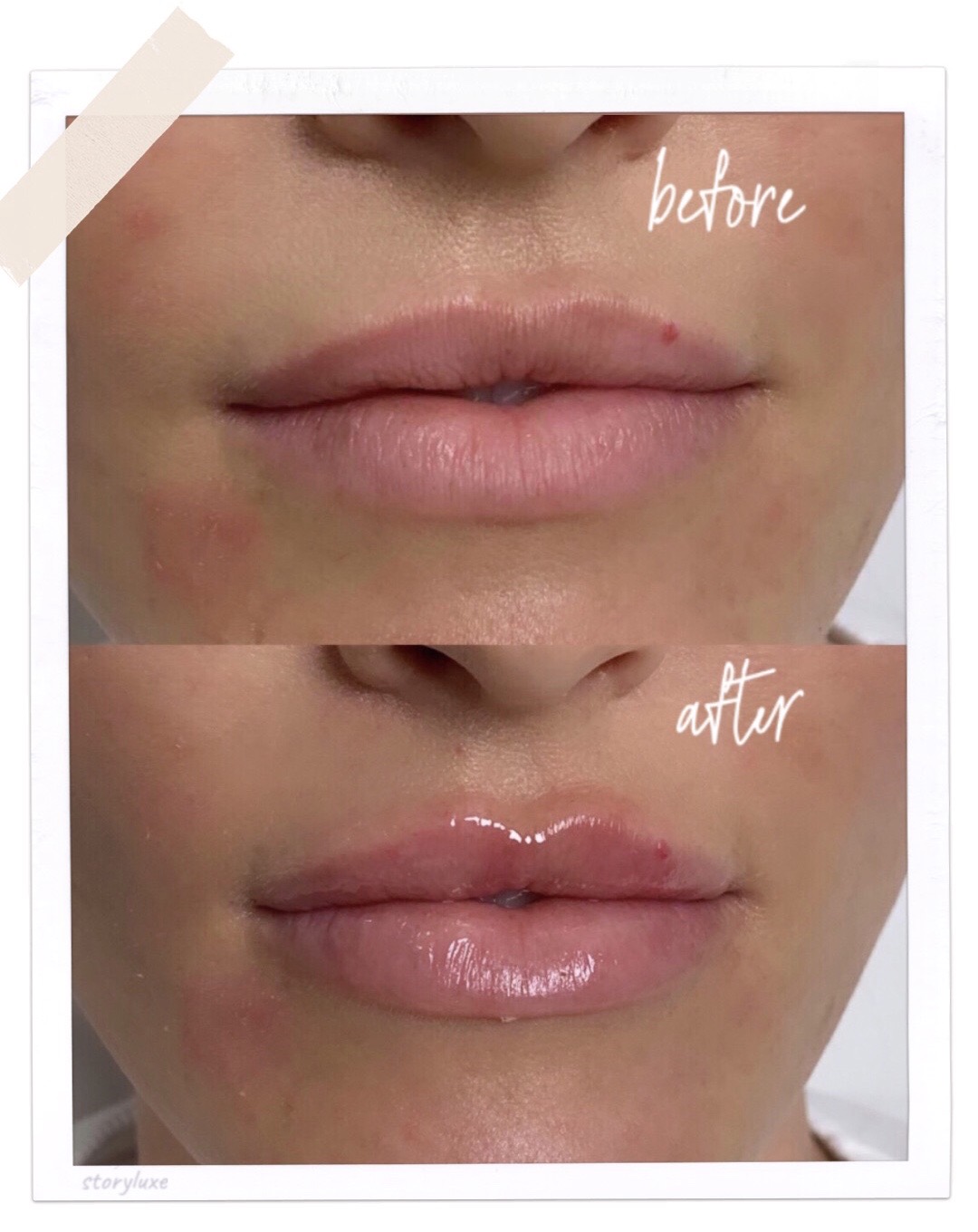 before and after lips