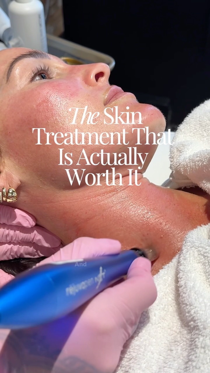 THE skin treatment that is actually worth it!💁🏻‍♀️ Consistent microneedling has changed the texture of my skin! The pen has tiny little needling that puncture the skin and stimulate collagen production - YES please! I’ve been doing it 2-3x/year for the past 4 years. Now that I’m 40 I’m so happy I added this into my skin routine! LOVE the glow I get about a week after doing it (in the video)✨✨

If you want to learn more I have a detailed blog post on LowToxHome.com - comment “SKIN” and I’ll send it to your DMs🙆🏻‍♀️

Thanks to @simplyskinmedispa for always doing this treatment for moi✨😘

#microneedlingtherapy #microneedlingbeforeandafter #skincaretreatment