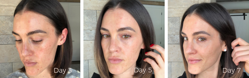BBL Laser skincare