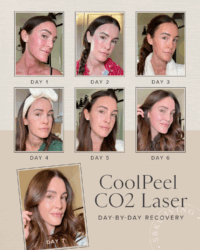 cool peel co2 laser