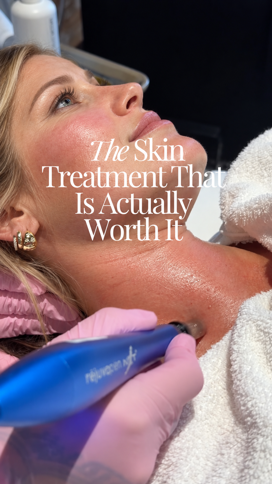 THE skin treatment that is actually worth it!💁🏻‍♀️ Consistent microneedling has changed the texture of my skin! The pen has tiny little needling that puncture the skin and stimulate collagen production - YES please! I’ve been doing it 2-3x/year for the past 4 years. Now that I’m 40 I’m so happy I added this into my skin routine! LOVE the glow I get about a week after doing it (in the video)✨✨

If you want to learn more I have a detailed blog post on LowToxHome.com - comment “SKIN” and I’ll send it to your DMs🙆🏻‍♀️

Thanks to @simplyskinmedispa for always doing this treatment for moi✨😘

#microneedlingtherapy #microneedlingbeforeandafter #skincaretreatment